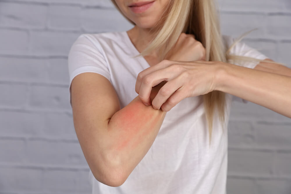 woman scratching arm because of allergies