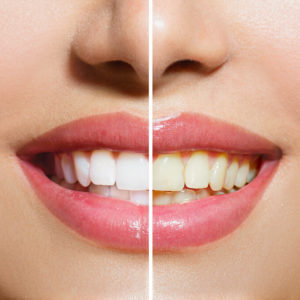 Woman Teeth Before and After oil pulling