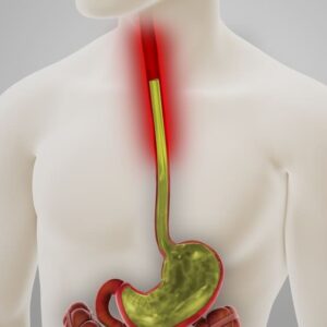 Acid Reflux GERD Disease 3D Illustration
