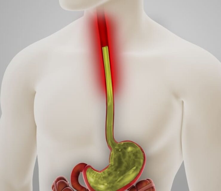 Acid Reflux GERD Disease 3D Illustration