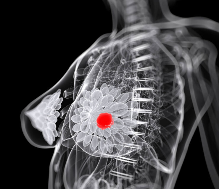 3d rendered medical illustration of breast cancer