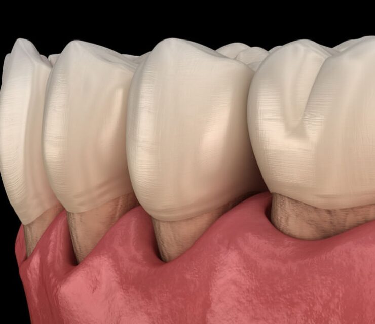 Gum recession process. Medically accurate 3D illustration