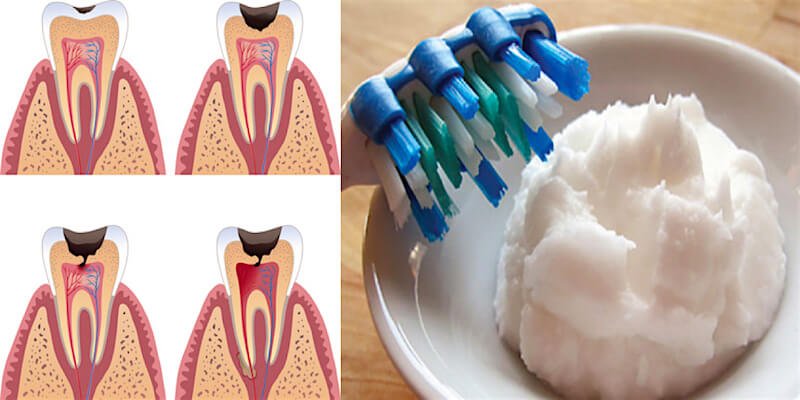 Reverse Cavities And Tooth Decay Naturally
