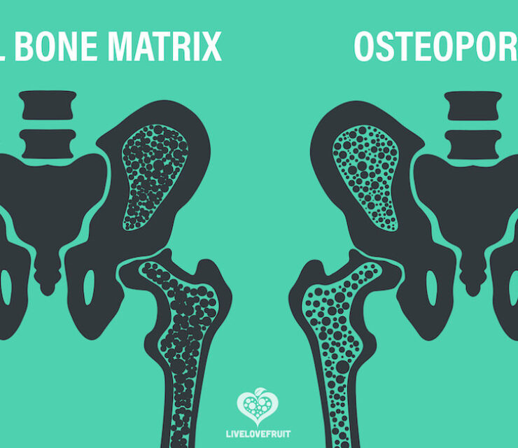 normal bone matrix compared to osteoporosis bones