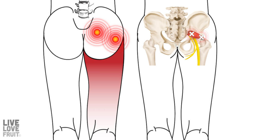 illustrated piriformis muscle showing trigger points and radiating pain