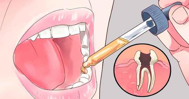 Natural Toothache Remedies 