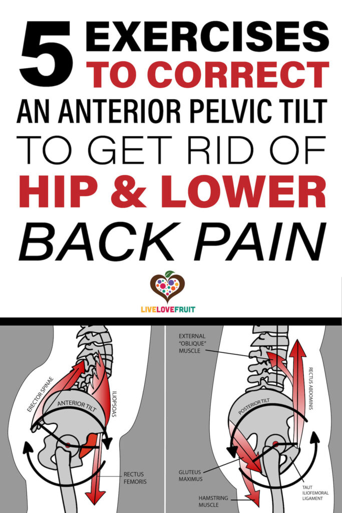 graphic anatomical representation of anterior pelvic tilt with text - 5 exercises to correct an anterior pelvic tilt to get rid of hip & lower back pain