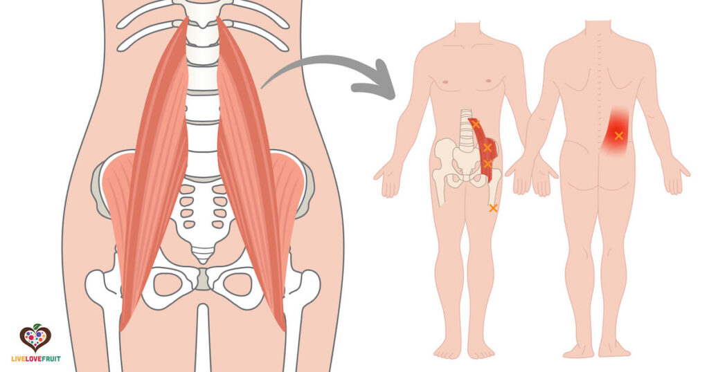 illustration of psoas muscle and trigger points within the psoas muscle