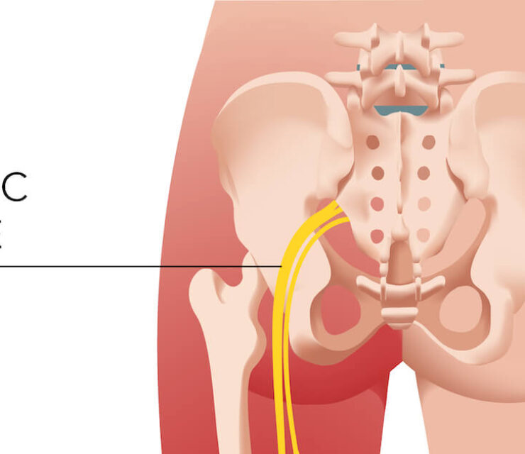 visual diagram of sciatic nerve pain