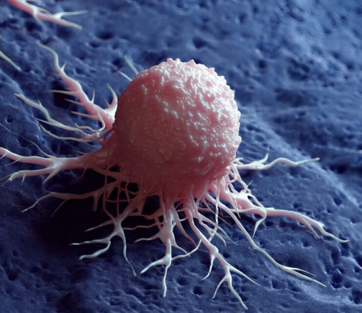 3d rendered medical illustration of a cancer cell