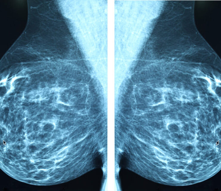 Mammogram radio imaging for breast cancer diagnosis
