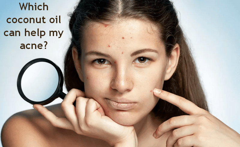 Girl pointing at her face thinking which coconut oil is best for her acne