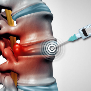 epidural steroid injections