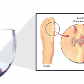 foods that cause gout flare ups