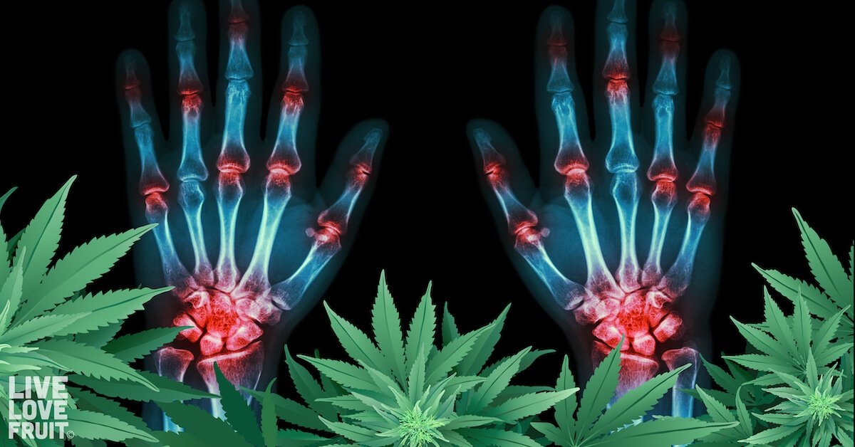 Cannabis for Arthritis: How One Plant is Being Used to Repair Arthritic Joints