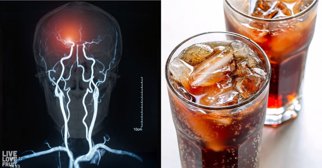 Diet Drinks and Dementia