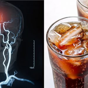 Diet Drinks and Dementia