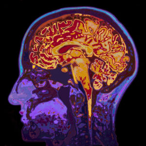 MRI image of a brain