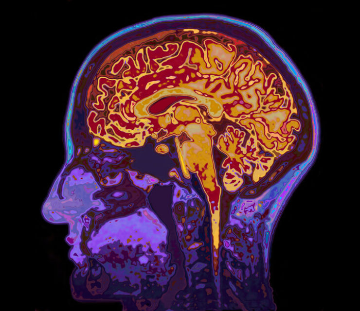 MRI image of a brain